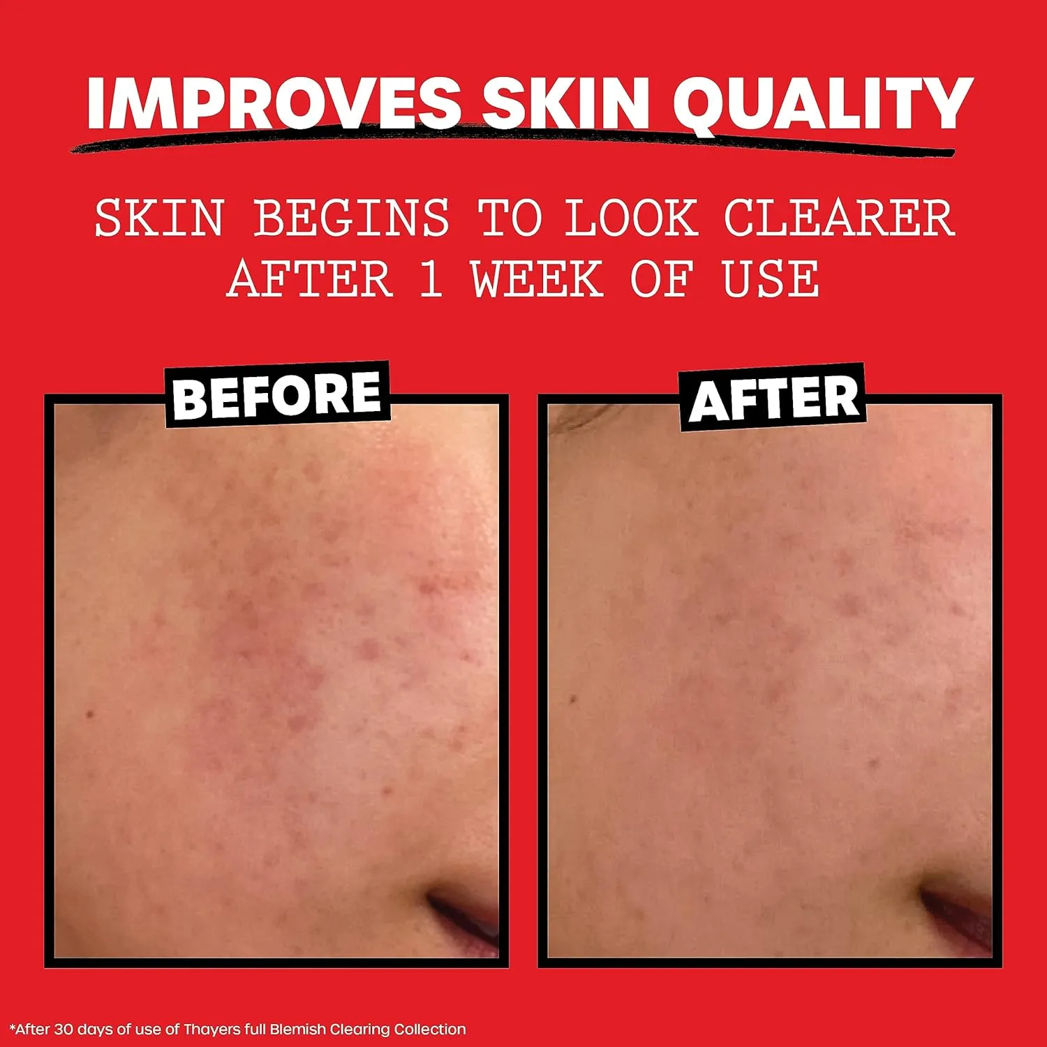 THAYERS Witch Hazel Blemish Cleanser, 4 Ounce
